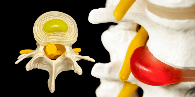 Bel Fıtığı Nedir?