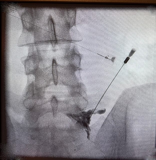 Skopi cihazı eşliğinde sinir köküne yapılan nokta atış (transforaminal enjeksiyon) işlemi ve ilacın yayılım görüntüsü.