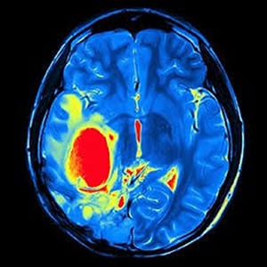 Beyin Tümörü Mr Görüntüsü