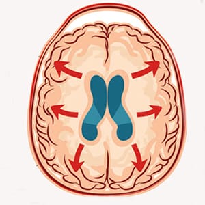 Hidrosefali (beyinde su toplanması) tedavisi ve şant ameliyatı