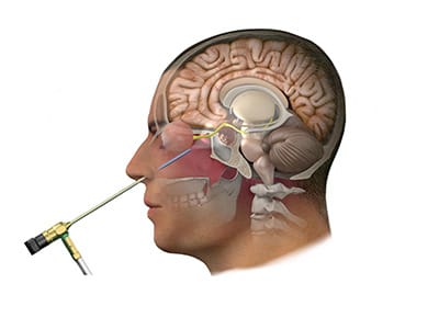 endoskopik hipofiz cerrahisi