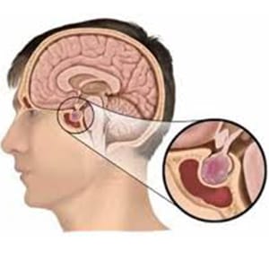 Hipofiz bezi tümörleri ve endoskopik cerrahi tedavisi