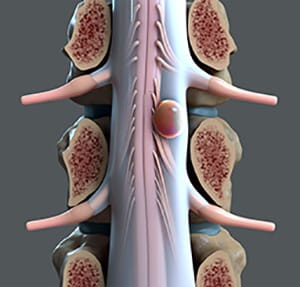 Omurga ve omurilik tümörleri MR görüntüsü ve cerrahi tedavisi